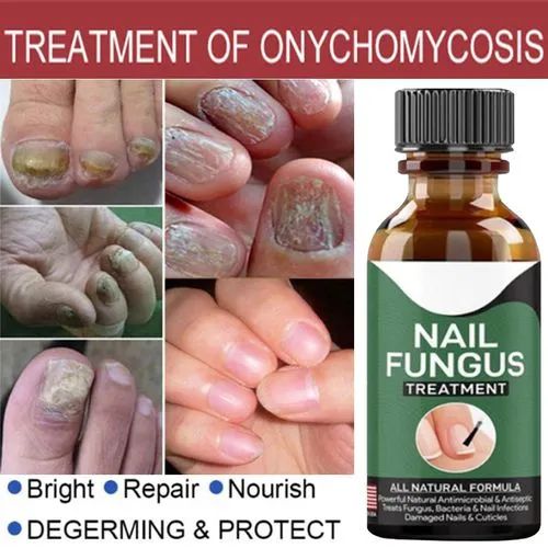 Nail Fungal Treatments Nail Repair Essences Serum