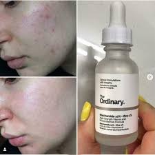 The Ordinary Niacinamide 10% + Zinc 1 % – 20 Ml |oil Control, Pore Minimizing & Blemish Solution Serum