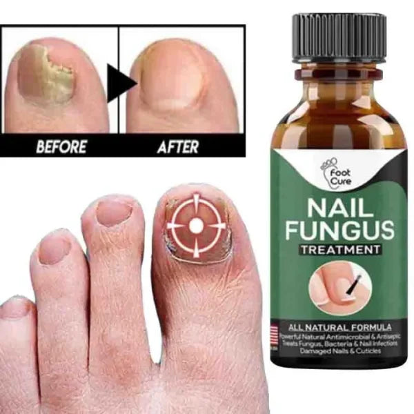 Nail Fungal Treatments Nail Repair Essences Serum